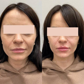 Уколы Botox/Dysport для лица