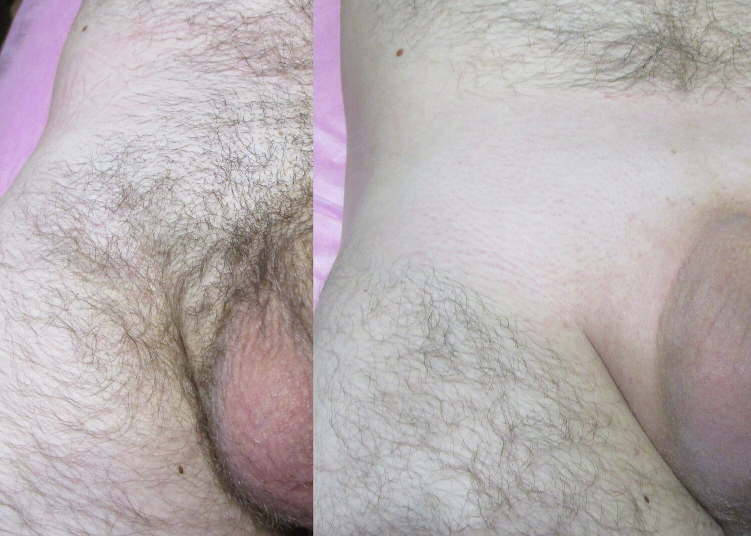 эпиляция на груди и животе у мужчин фото 119