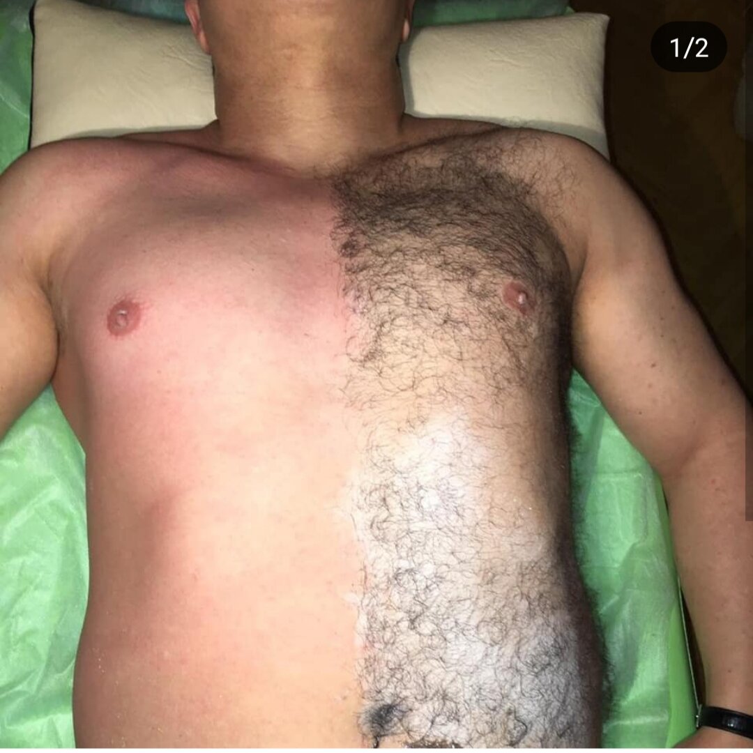 эпиляция груди у мужчин фото 24