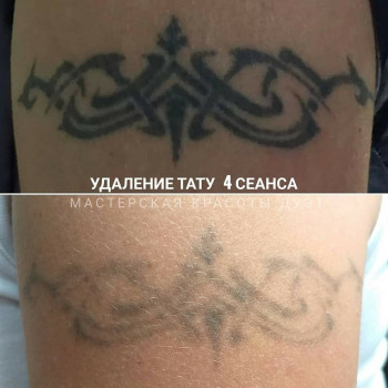 Удаление татуировки
