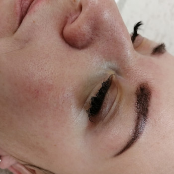 До:Чистка +миндальный пилинг 