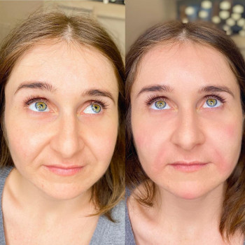 Коррекция носогубных складок