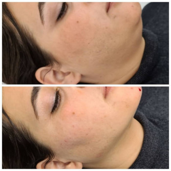 Коррекция скул и подбородка