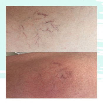 Лечение сосудов лазером