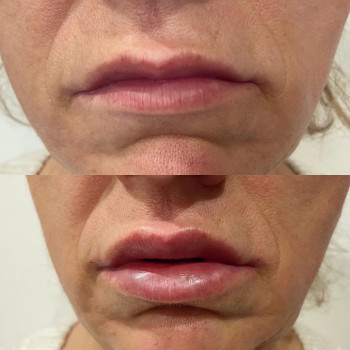 Коррекция и увеличение губ 