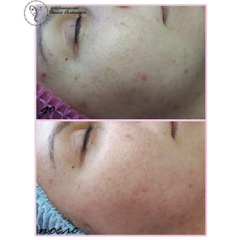 Результат процедуры карбокситерапии.