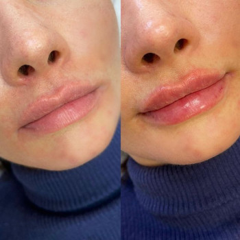 Деликатное увеличение