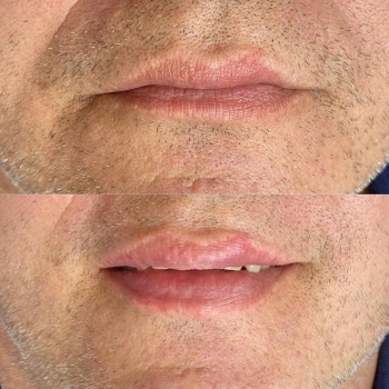 Коррекция формы мужских губ. 