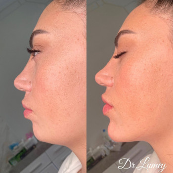 Инъекции подбородка