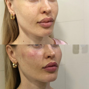 Исправление гиперкоррекции носослезной борозды.