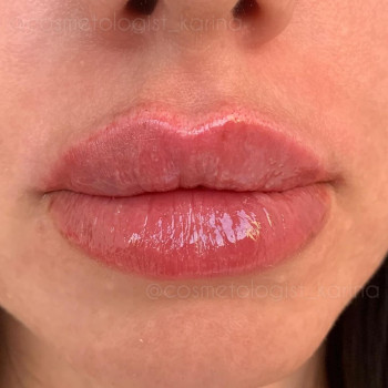 Увеличение губ