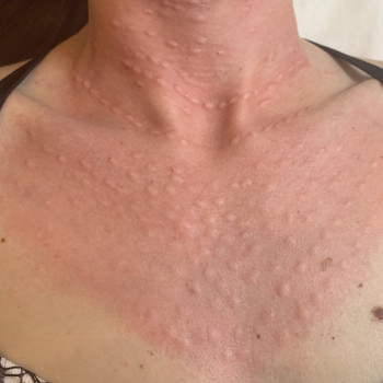 Биоревитализация шеи и декольте