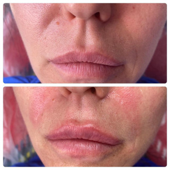 Носогубные складки и лифтинг губ