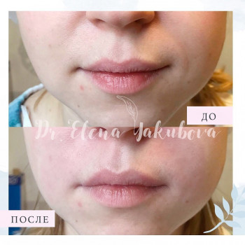 На фото: коррекция носогубных складок 