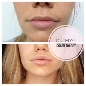 Контурная пластика губ