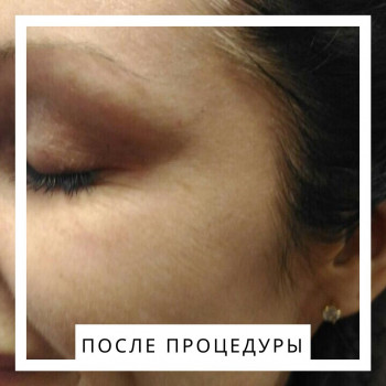 Коррекция морщин на внешних уголках глаз.
