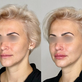 Результат проведения контурной пластики губ и носогубных скл