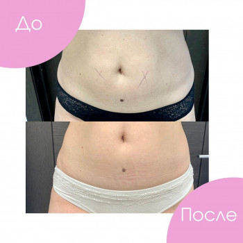 Криолиполиз области живота