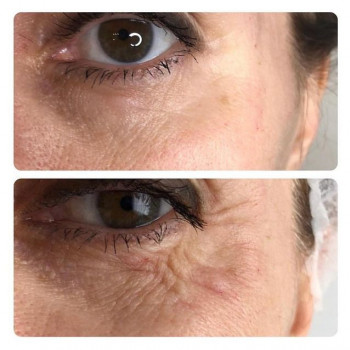 Действие ботулотксина вокруг глаз