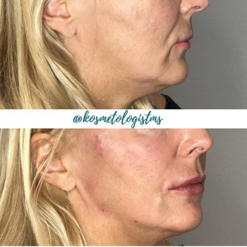 Контурная пластика 