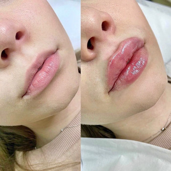 Увеличение губ препаратом на основе Гиалуроновой Кислоты