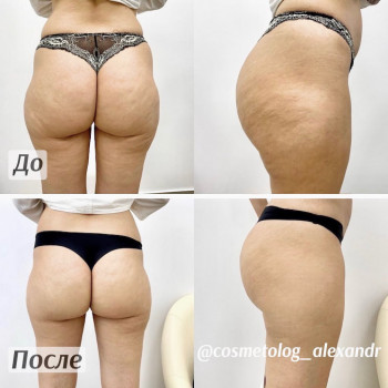 Коррекция ягодиц ботулотоксином с целью получения лифтинг-эф