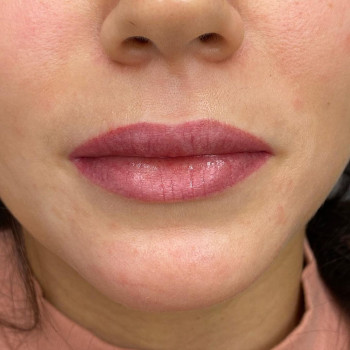 омоложение губ 