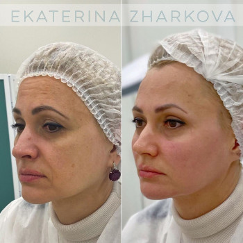 Коррекция мимических морщин препаратом ксеомин