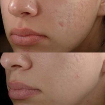 Промежуточный результат после курса мезотерапии