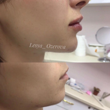 Увеличение подбородка 