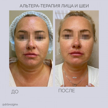 Уколы Botox
