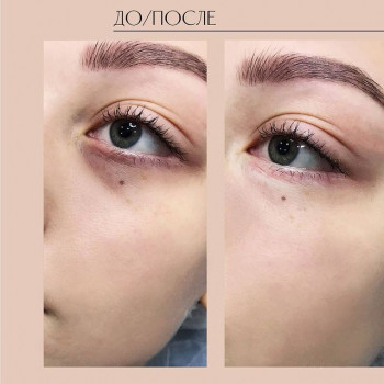 Коррекция носослезной борозды филлером