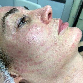 Биоревитализация