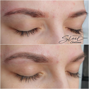 Красные бровки до лазерного удаления и сразу после