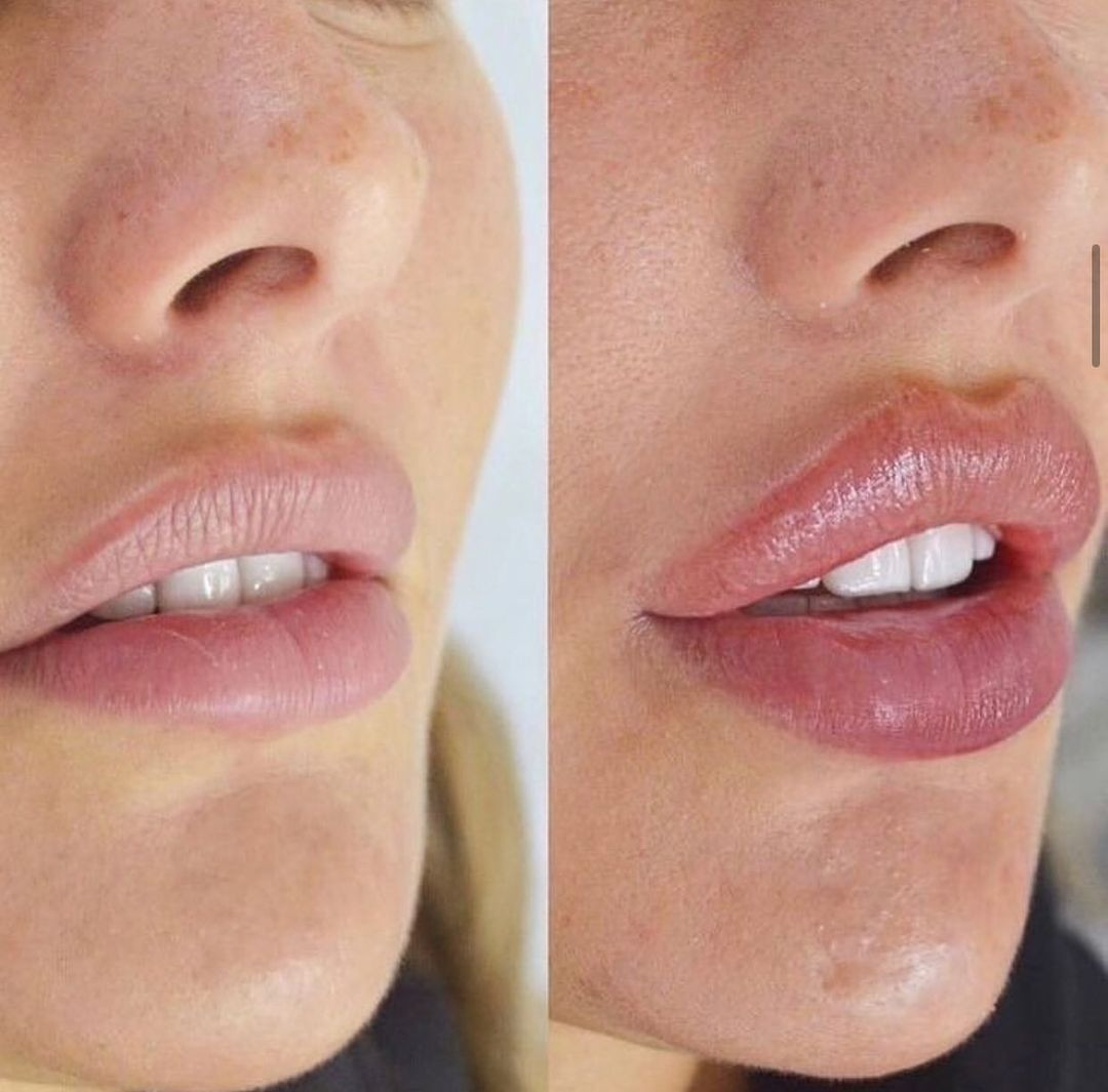 Увеличение губ до и после отзывы. Рефрешинг губ гиалуроновой кислотой. Гиалуроновая кислота в губы 1 мл. Губы накаченные гиалуроновой кислотой 1 мл.