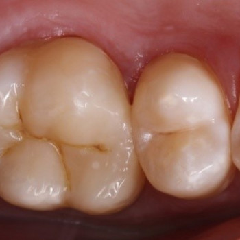 Удаление зубов под наркозом