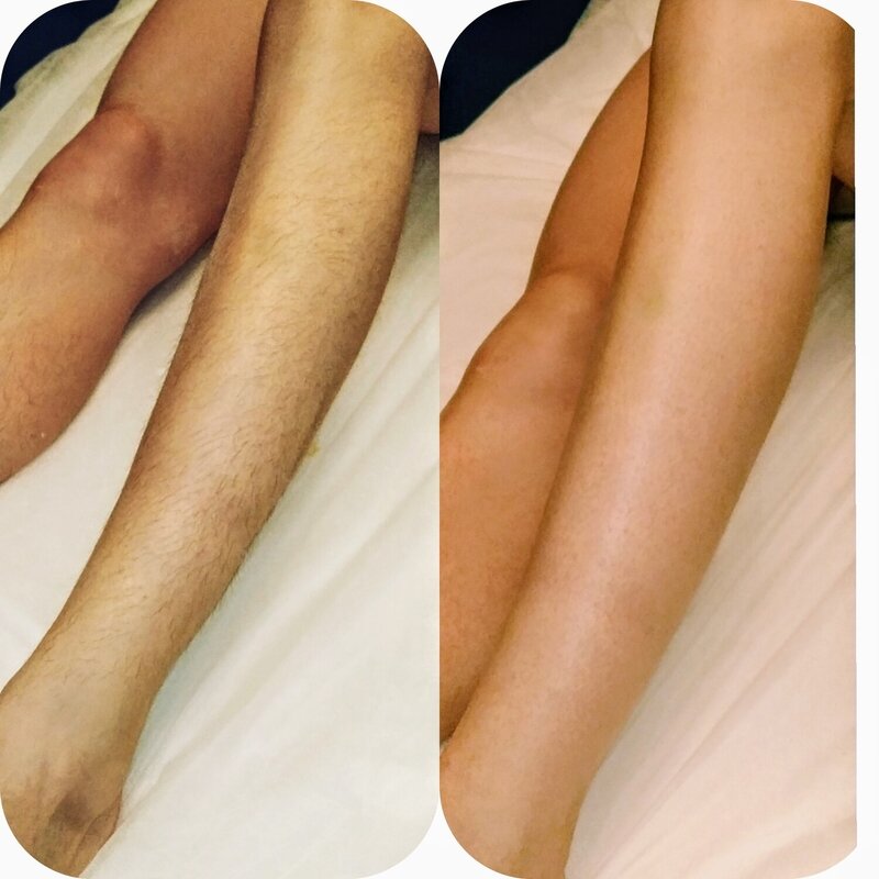 Лазерная эпиляция ноги skinlift. Депиляция ног. Депиляция ног воском. Депиляция ног до и после.