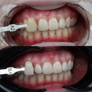 Удаление зубов