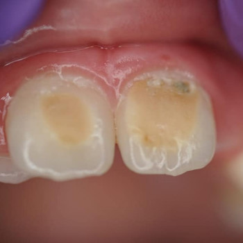 Удаление молочного зуба