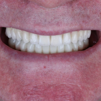 Профессиональная чистка зубов и полости рта
