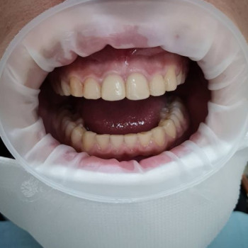 Профессиональная чистка зубов и полости рта