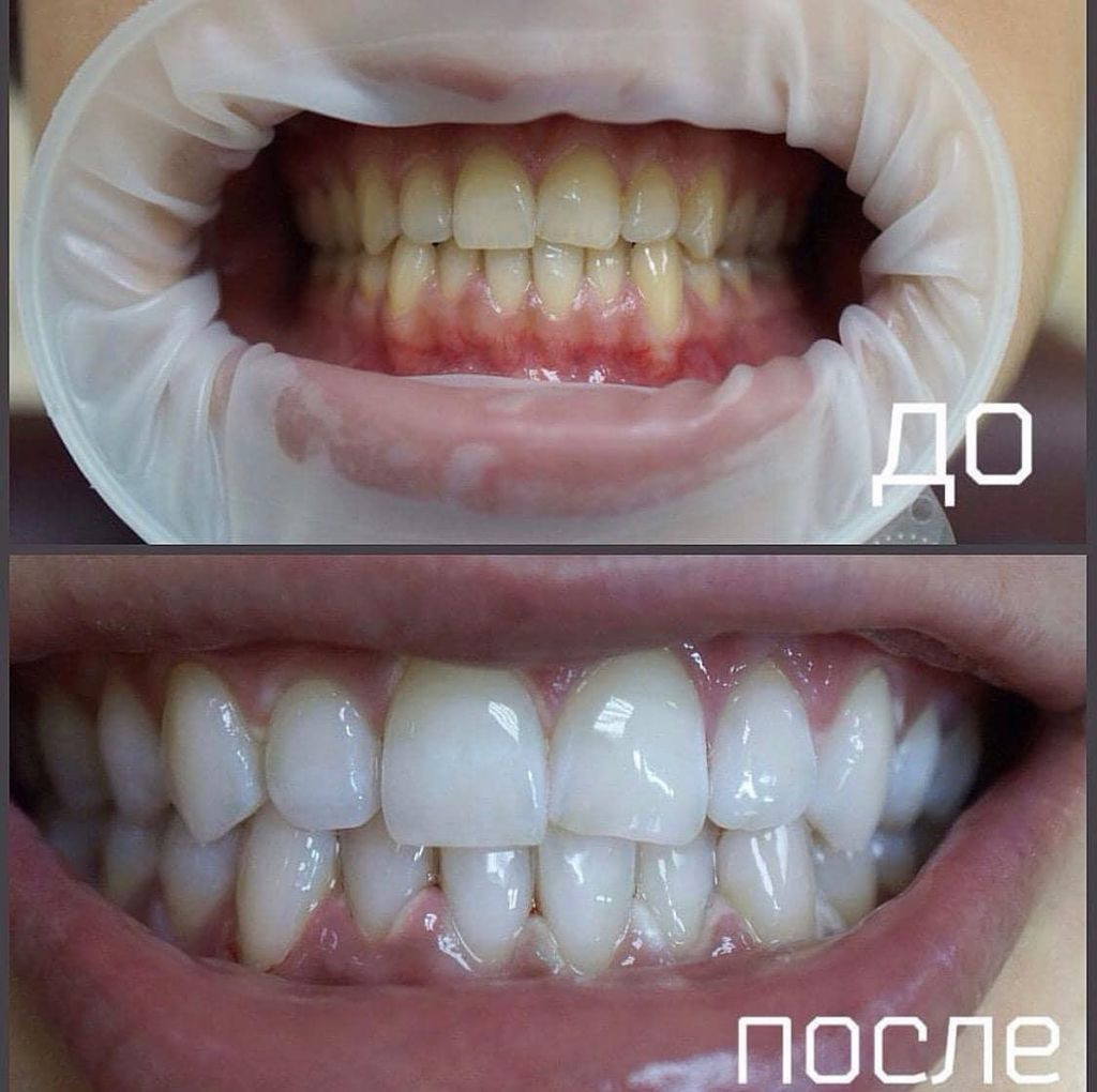 Отбеливание зубов самара. Отбеливание у стоматолога до и после. Отбеливание зубов у стоматолога до и после. Отбеливание зубов в Омске.