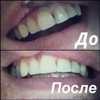 Отбеливание зубов Opalescence