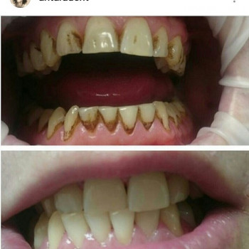 Чистка зубов ультразвуком