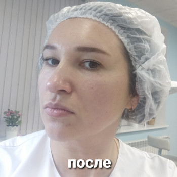 ПОСЛЕ
Биоревитализация.