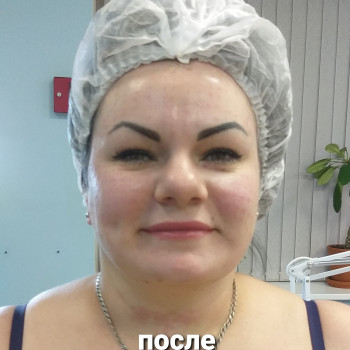 ПОСЛЕ.  Биоревитализация. 