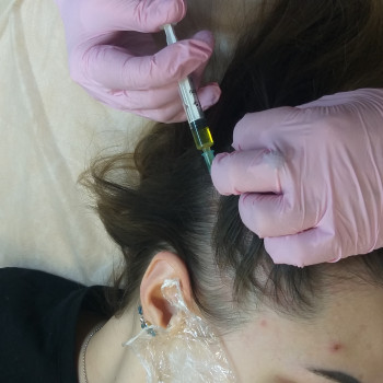 Мезотерапия волосистой части головы 