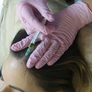 Мезотерапия волосистой части головы 