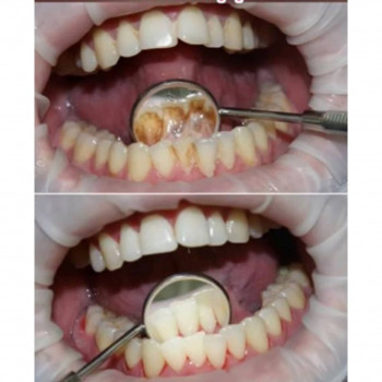 Пломбирование зубных каналов