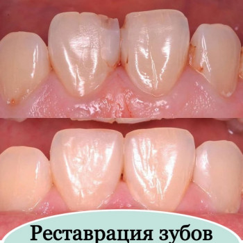 Реставрация зубов